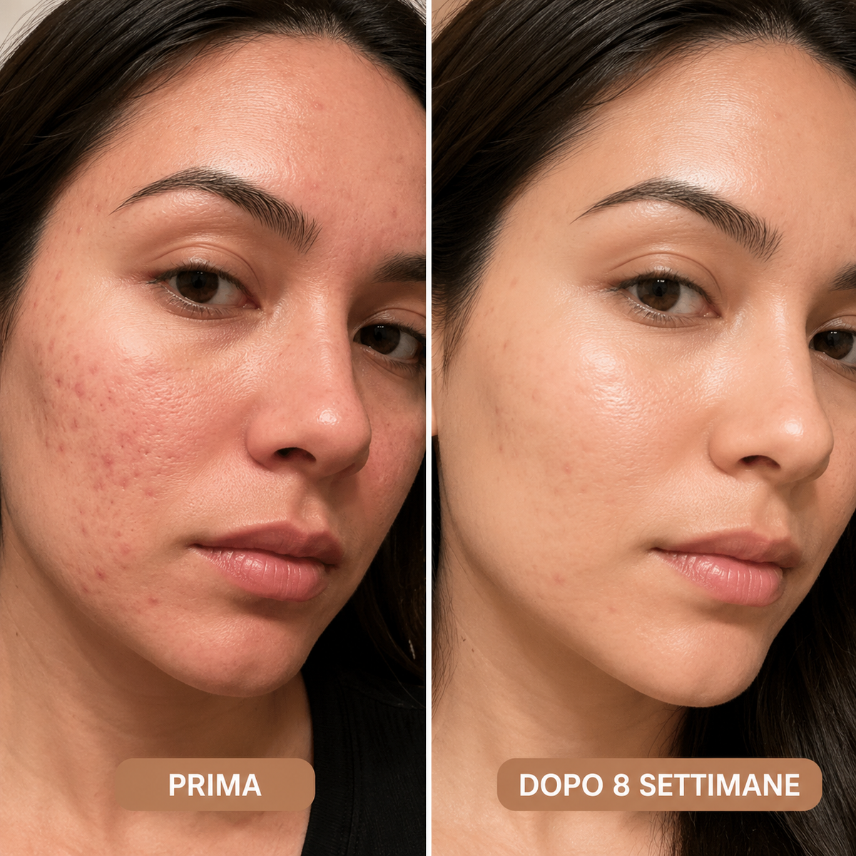 ScarSilk™ - Stick al Silicone Medicale per Cicatrici da Acne
